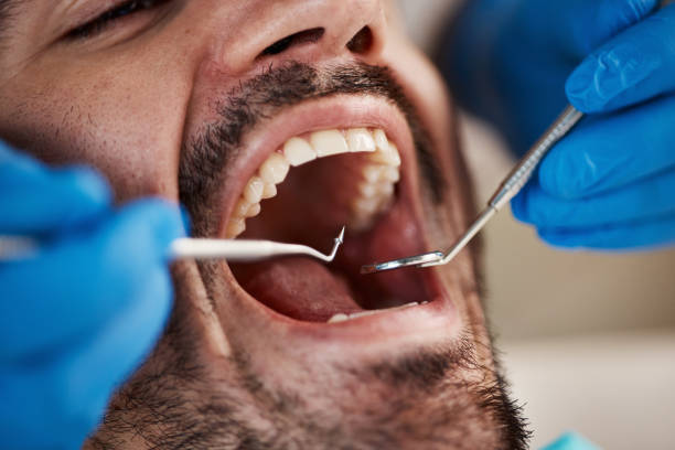 Best Emergency Dentist for Lost Fillings or Crowns in Bear Creek Ranch, TX